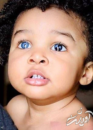 چشمان شگفت‌انگیز با اختلال ژنتیکی